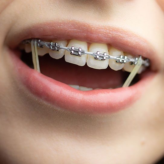 A Closer Look at Your Orthodontic Hardware - MyOrthodontist - MyOrthodontist -